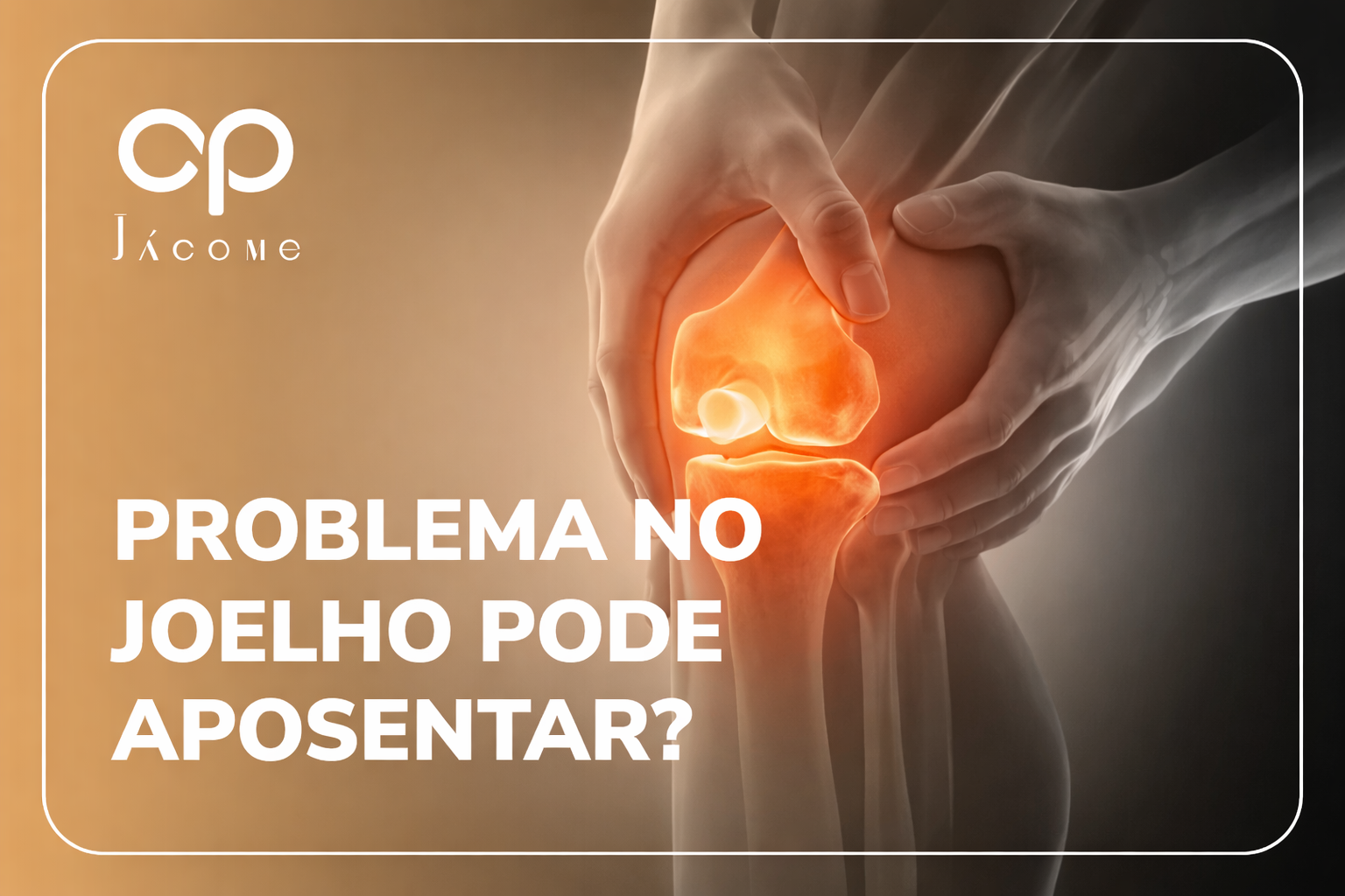 Especialistas em Direito Previdenciário alertam que problemas no joelho podem, sim, levar à concessão de aposentadoria ou outros benefícios, mas apenas quando analisados de forma individualizada e à luz das regras previdenciárias aplicáveis. O ponto central está em como a limitação funcional afeta a capacidade de trabalho, considerando fatores como profissão exercida, idade, histórico contributivo e possibilidade real de reabilitação. Na prática, segurados com problemas semelhantes no joelho podem ter desfechos completamente diferentes perante o INSS. Enquanto alguns fazem jus apenas ao auxílio por incapacidade temporária, outros podem se enquadrar em aposentadoria por incapacidade permanente, aposentadoria da pessoa com deficiência, auxílio-acidente ou até mesmo no BPC/LOAS, a depender do grau e da duração da limitação, da origem da lesão, da condição socioeconômica e da qualidade da documentação apresentada. A ausência de uma estratégia previdenciária adequada e de provas bem estruturadas costuma resultar em indeferimentos, atrasos e concessões equivocadas de benefícios. Problema no joelho pode aposentar?